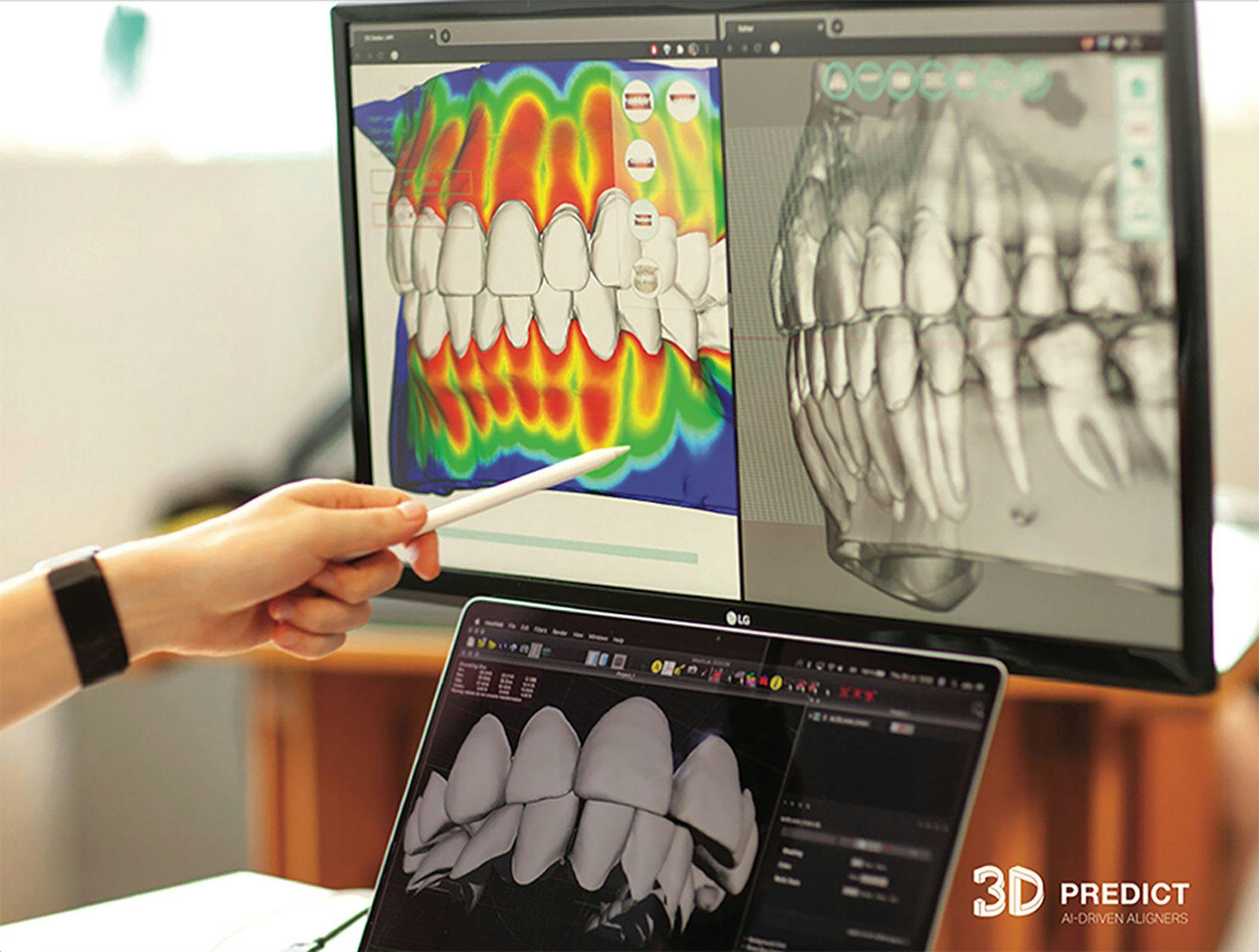 A Clear Aligner Solution Rooted in Artificial Intelligence Technology