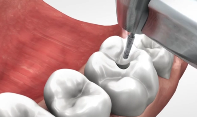 Preparation rules for ceramic inlays and partial crowns