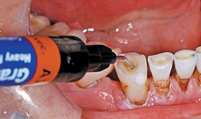 How to manage exposed dentin: a great patient service