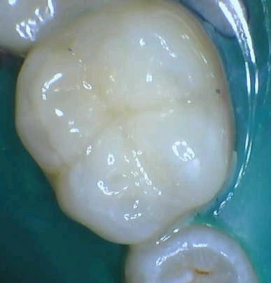 How to Perform Occlusal Bonding with an Omni-Chromatic Restorative