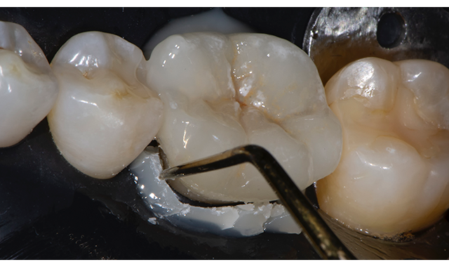 How to Simplify Cementation of a supragingival Lithium Disilicate Crown with New Adhesive Technology