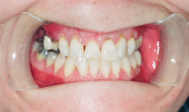 How to use fluoride varnish in patients with ‘meth mouth’