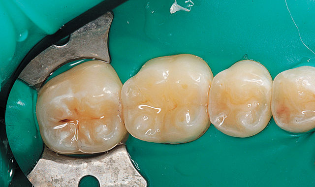 How to efficiently place posterior direct composites